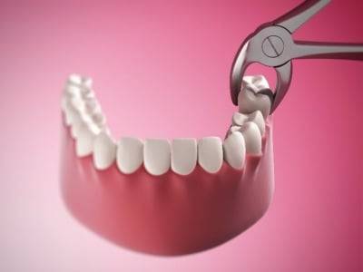 Peut-on vaper après l’extraction des dents de sagesse ?