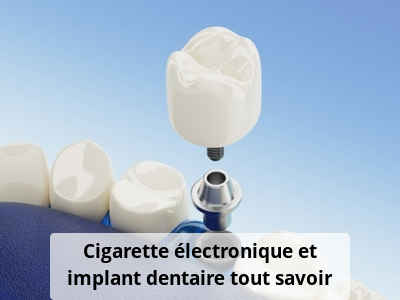 Cigarette électronique et implant dentaire, tout savoir