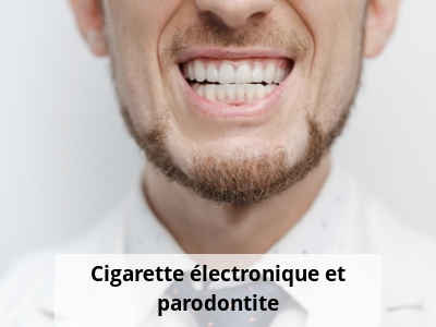 Cigarette électronique et parodontite