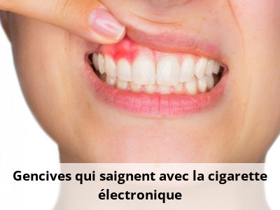 Gencives qui saignent avec la cigarette électronique