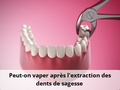 Peut-on vaper après l’extraction des dents de sagesse ?